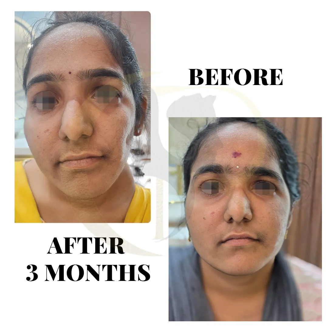 Frontal facial symmetry restoration using fat grafting with Vaser Technology for Hemifacial Microsomia at Cosmo Radiance Hyderabad India