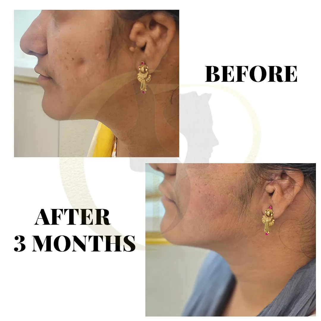 Facial symmetry correction using fat grafting with Vaser Technology for Hemifacial Microsomia side profile result at Cosmo Radiance Hyderabad India