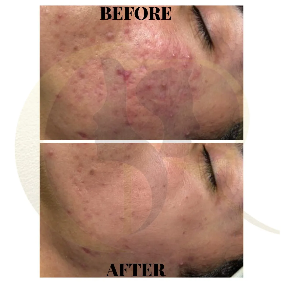 Male acne scar treatment using Scarlet S MNRF and Fotona Starwalker MAQX laser skin toning result after 5 sessions in 3 months at Cosmo Radiance Hyderabad India