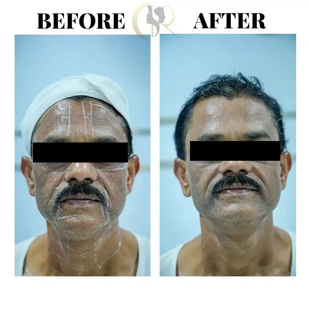 Male anti-aging robotic face lift before and after result using Ultraformer MPT showing skin tightening at Cosmo Radiance Hyderabad India Male anti-aging robotic face lift before and after result using Ultraformer MPT showing skin tightening at Cosmo Radiance Hyderabad India