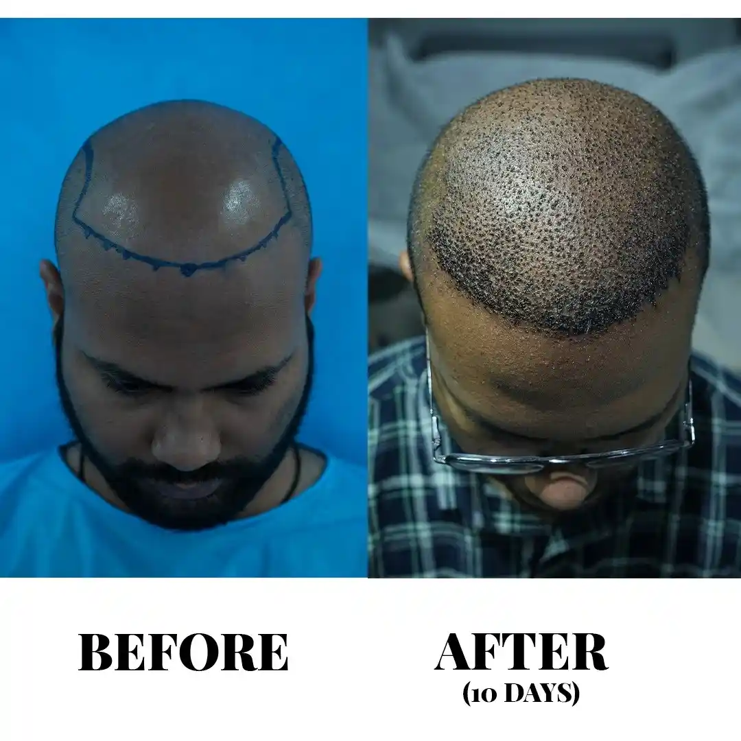 Advanced FUE Hair Transplant in Hyderabad | Sapphire FUE Cost & Packages Advanced FUE Hair Transplant in Hyderabad | Sapphire FUE Cost & Packages