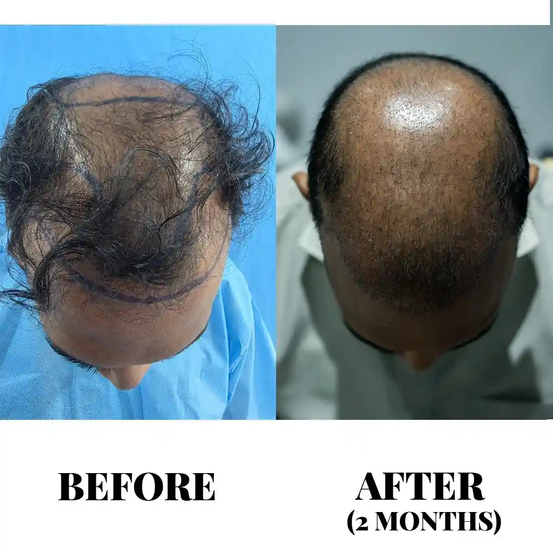 Advanced FUE Hair Transplant in Hyderabad | Sapphire FUE Cost & Packages Advanced FUE Hair Transplant in Hyderabad | Sapphire FUE Cost & Packages