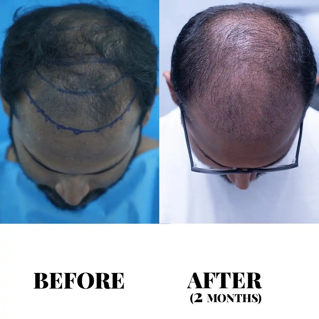 Advanced FUE Hair Transplant in Hyderabad | Sapphire FUE Cost & Packages Advanced FUE Hair Transplant in Hyderabad | Sapphire FUE Cost & Packages