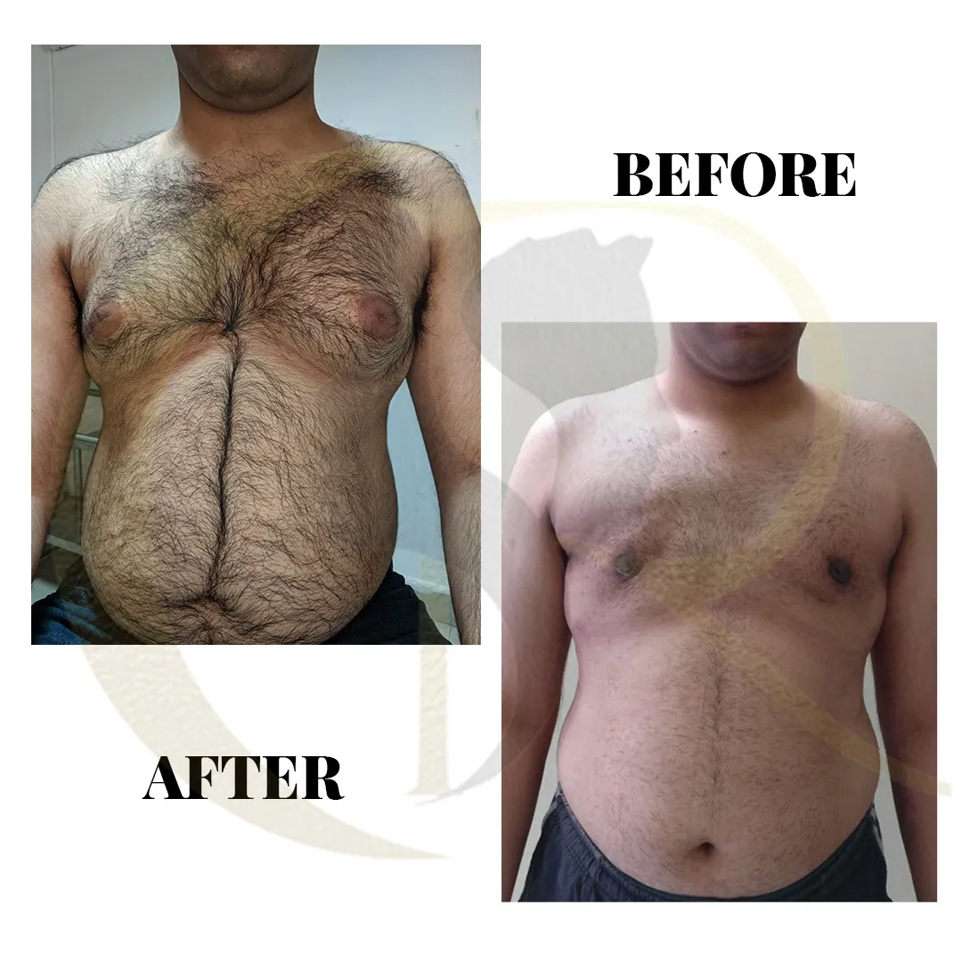 Male chest contouring and gland excision using Vaser 2.0 Ventx console and Vaser Smooth at Cosmo Radiance Hyderabad India