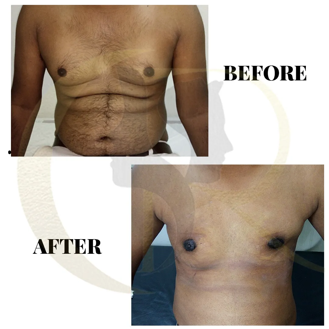 Gynecomastia surgery result showing male chest contouring on Day 5 post Vaser 2.0 Ventx Vaser Smooth procedure at Cosmo Radiance Hyderabad India