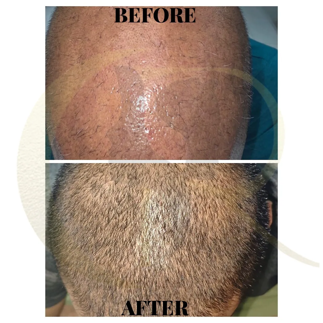 Crown area hair transplant growth showing density improvement after 3 months at Cosmo Radiance Hyderabad India