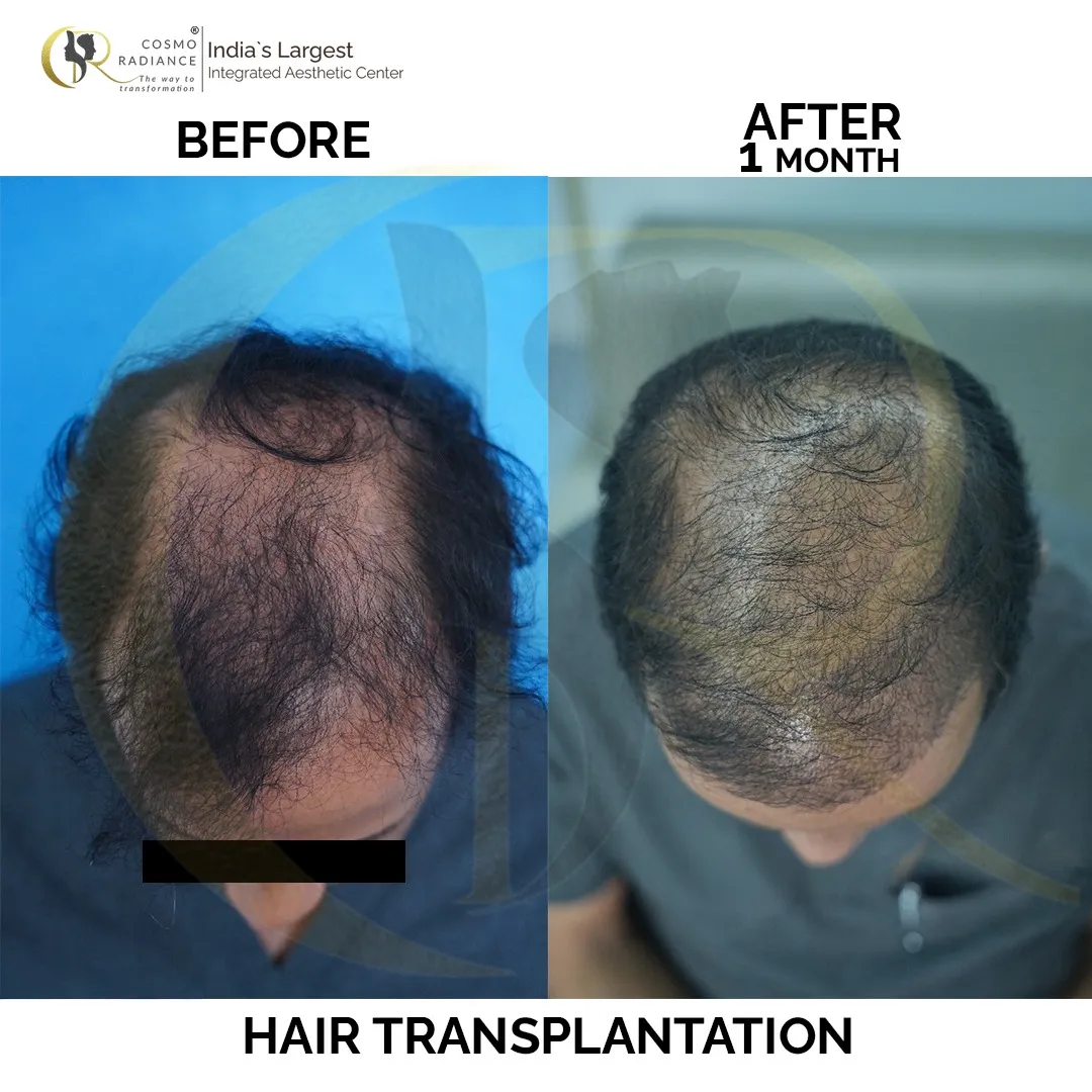 Crown area hair density improvement 2 months after FUE + DHI hair transplant at Cosmo Radiance Hyderabad India