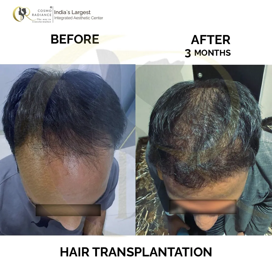 Hairline restoration showing significant hair growth 3 months after FUE + DHI hair transplant at Cosmo Radiance Hyderabad India