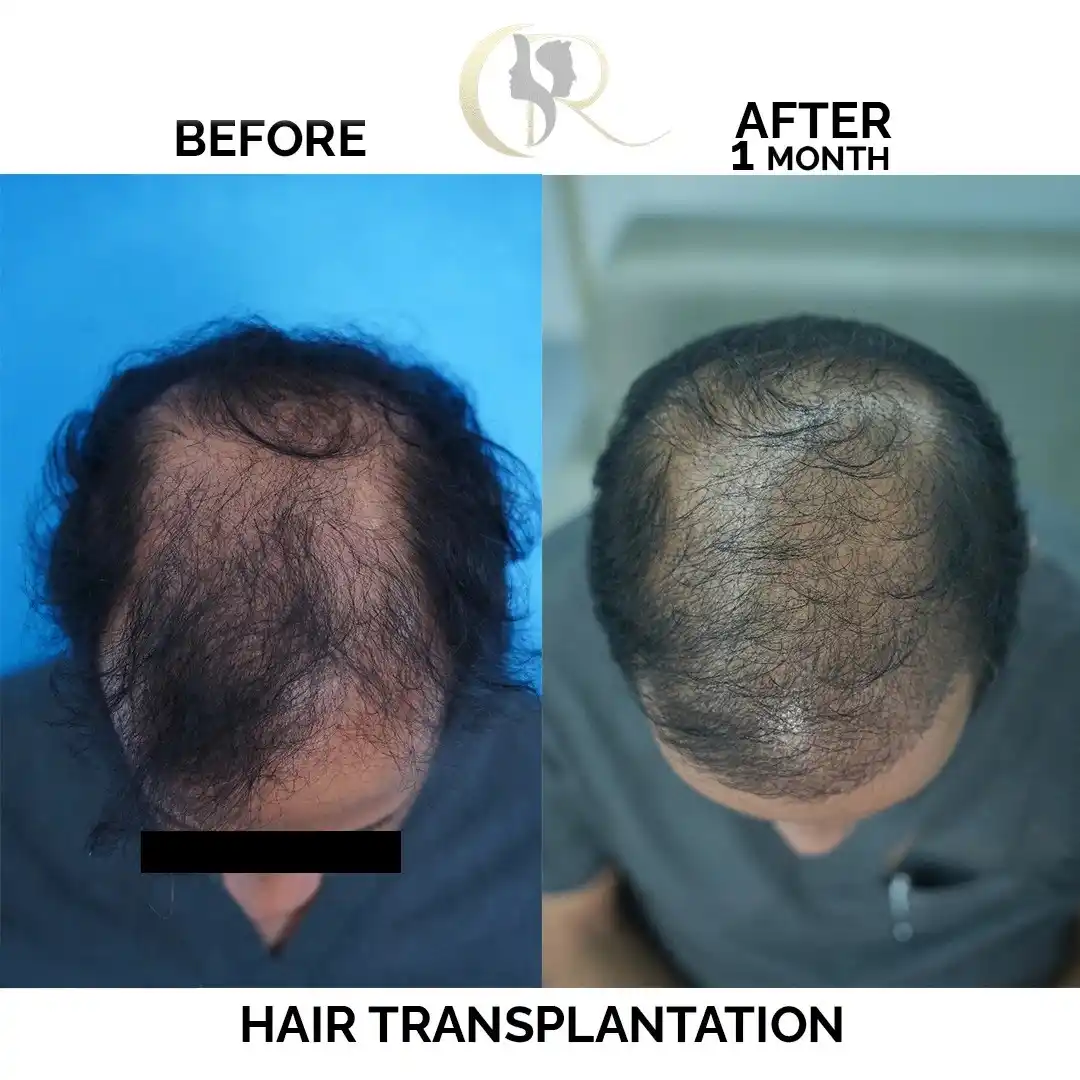 Advanced Body Hair Transplant (BHT) in Hyderabad | Beard to Scalp Cost Advanced Body Hair Transplant (BHT) in Hyderabad | Beard to Scalp Cost