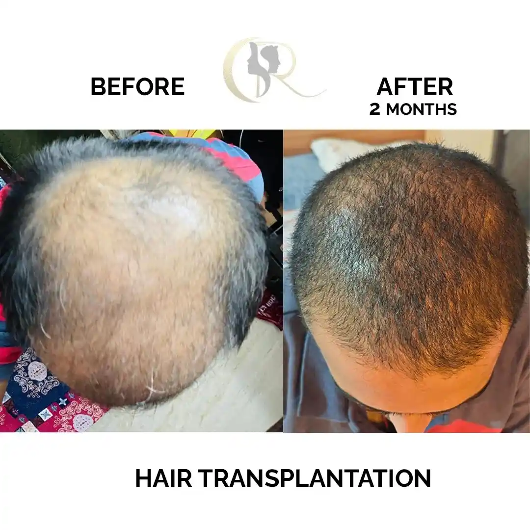 Hair transplant result showing improved hair density 2 months after FUE + DHT procedure at Cosmo Radiance Hyderabad India Hair transplant result showing improved hair density 2 months after FUE + DHT procedure at Cosmo Radiance Hyderabad India