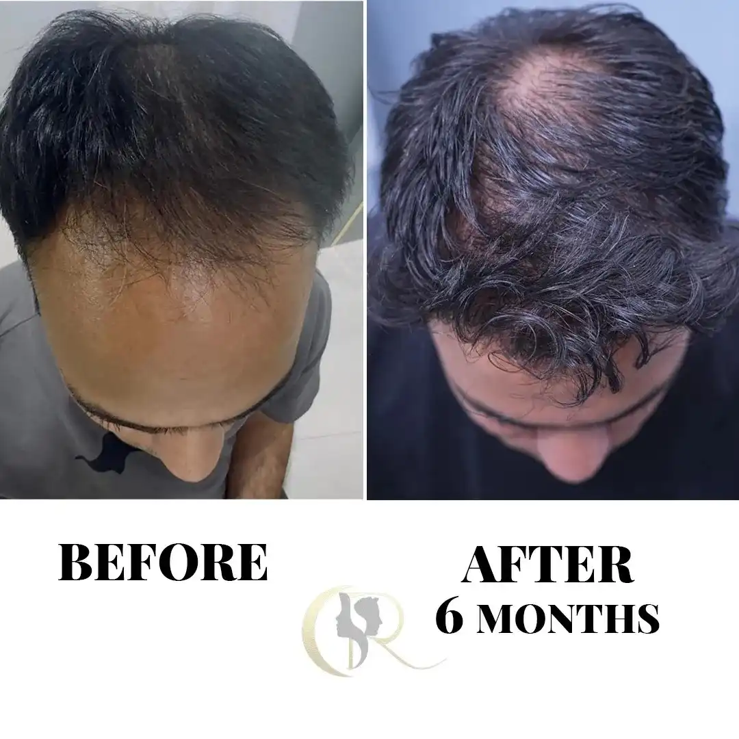 Advanced FUE Hair Transplant in Hyderabad | Sapphire FUE Cost & Packages Advanced FUE Hair Transplant in Hyderabad | Sapphire FUE Cost & Packages