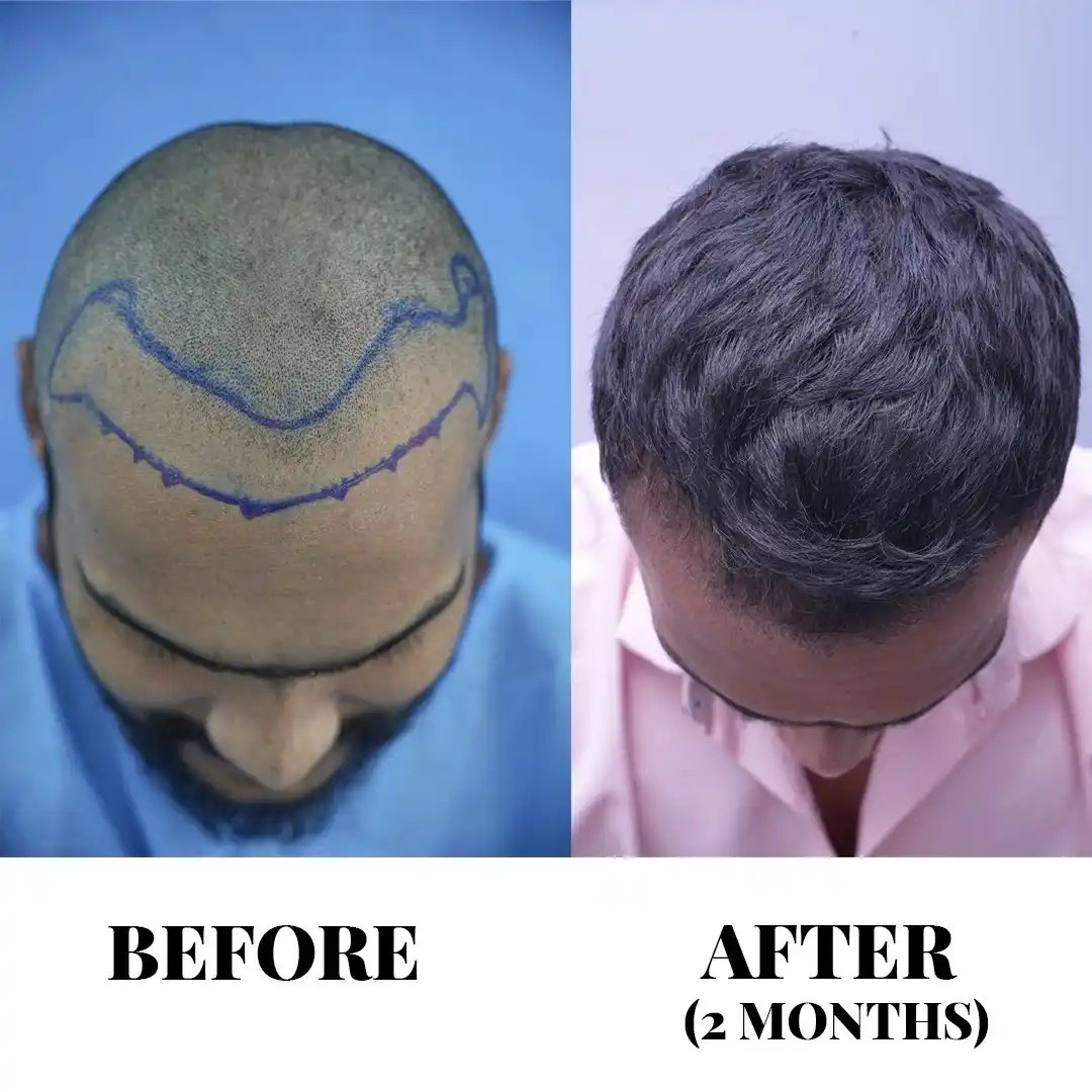 Advanced FUE Hair Transplant in Hyderabad | Sapphire FUE Cost & Packages Advanced FUE Hair Transplant in Hyderabad | Sapphire FUE Cost & Packages