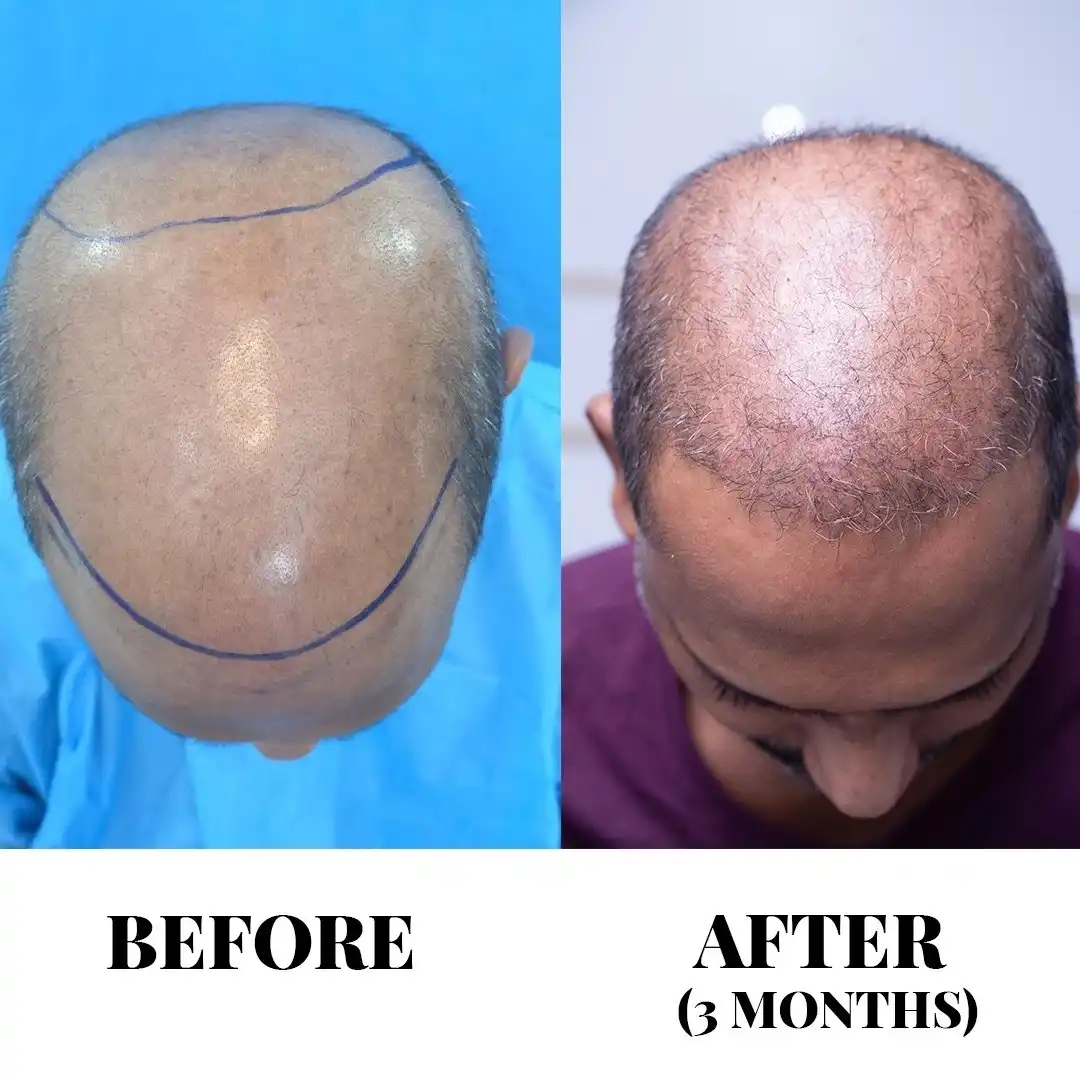 Advanced FUE Hair Transplant in Hyderabad | Sapphire FUE Cost & Packages Advanced FUE Hair Transplant in Hyderabad | Sapphire FUE Cost & Packages