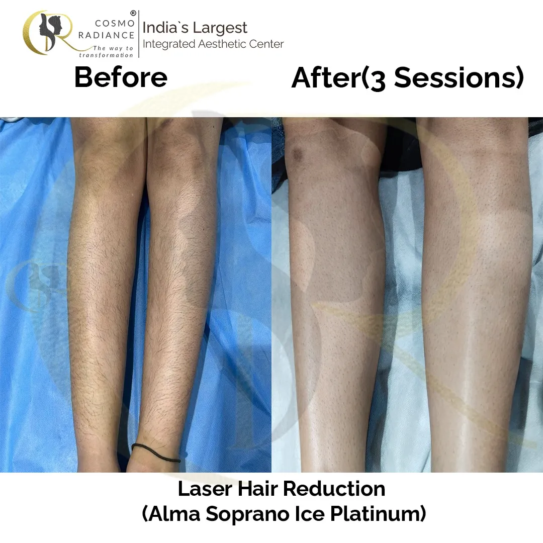 Laser hair removal result on legs after 2 sessions using Alma Soprano Platinum Special Edition at Cosmo Radiance Hyderabad India