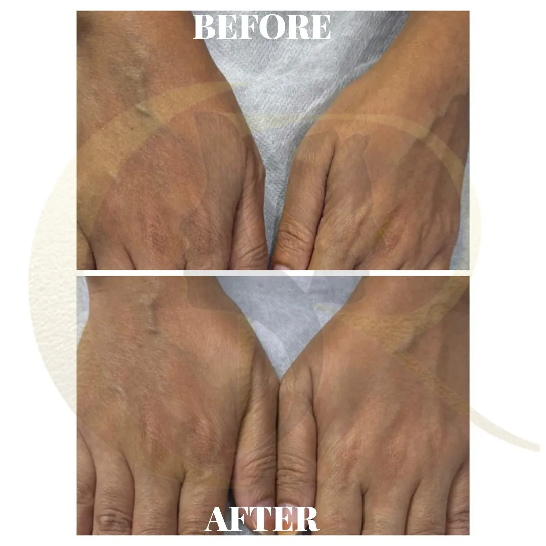 Hand rejuvenation using PDRN treatment showing skin texture improvement after 10 days at Cosmo Radiance Hyderabad India