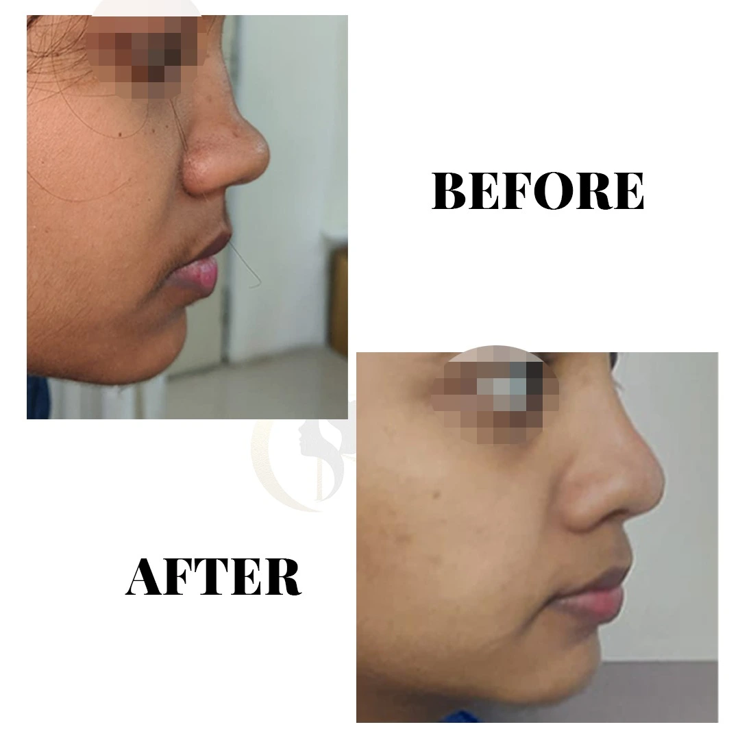 Nasal tip refinement and nostril symmetry basal view result at Cosmo Radiance Hyderabad India