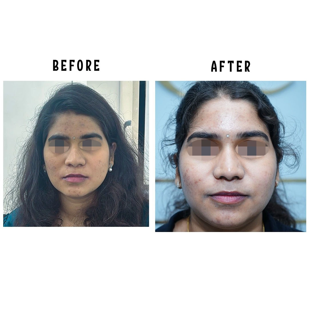 Female rhinoplasty result showing improved nasal symmetry and frontal aesthetics at Cosmo Radiance Hyderabad India