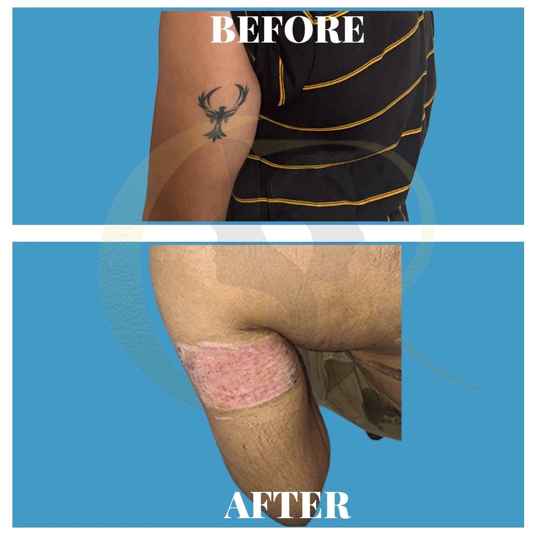 Tattoo removal single session ablative resurfacing result using Candela CO2RE and Fotona Starwalker MAQX Fractat surgical technique at Cosmo Radiance Hyderabad India