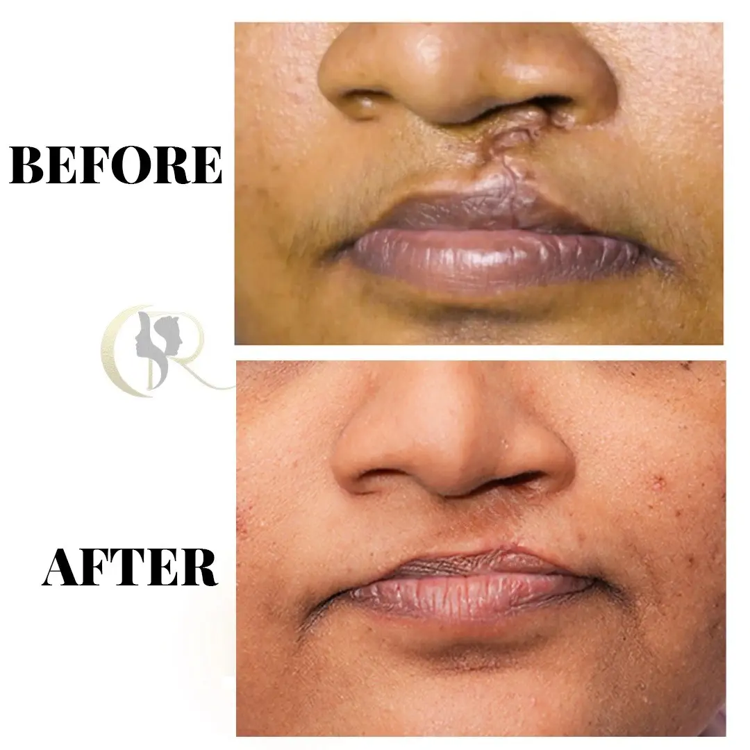 Cleft Lip Scar Revision - Integrated Treatment (5 Sessions) Cleft Lip Scar Revision - Integrated Treatment (5 Sessions)