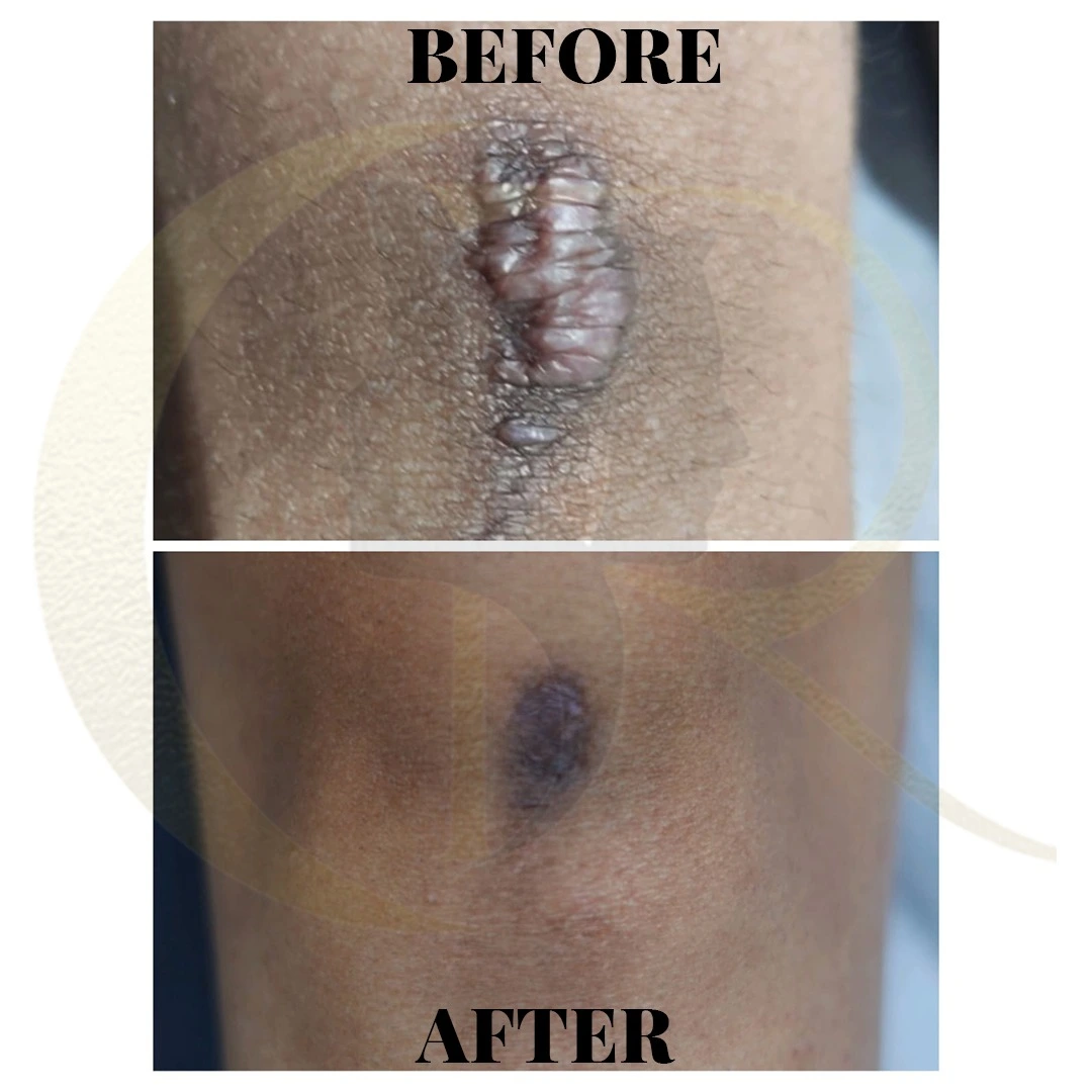 Keloid treatment result showing significant flattening and scar reduction after 5 sessions at Cosmo Radiance Hyderabad India