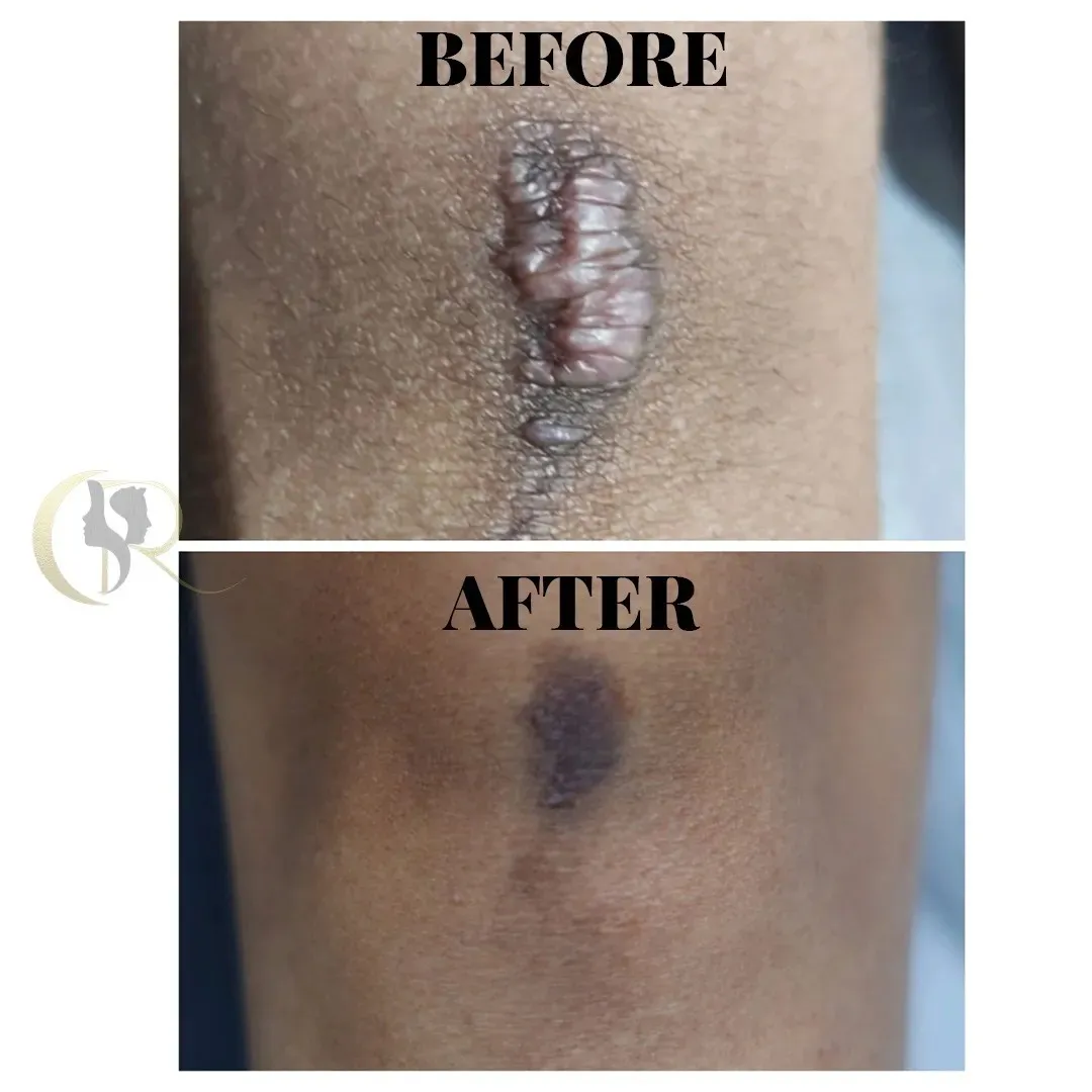 Keloid Scar Treatment - 5 Sessions Result Keloid Scar Treatment - 5 Sessions Result