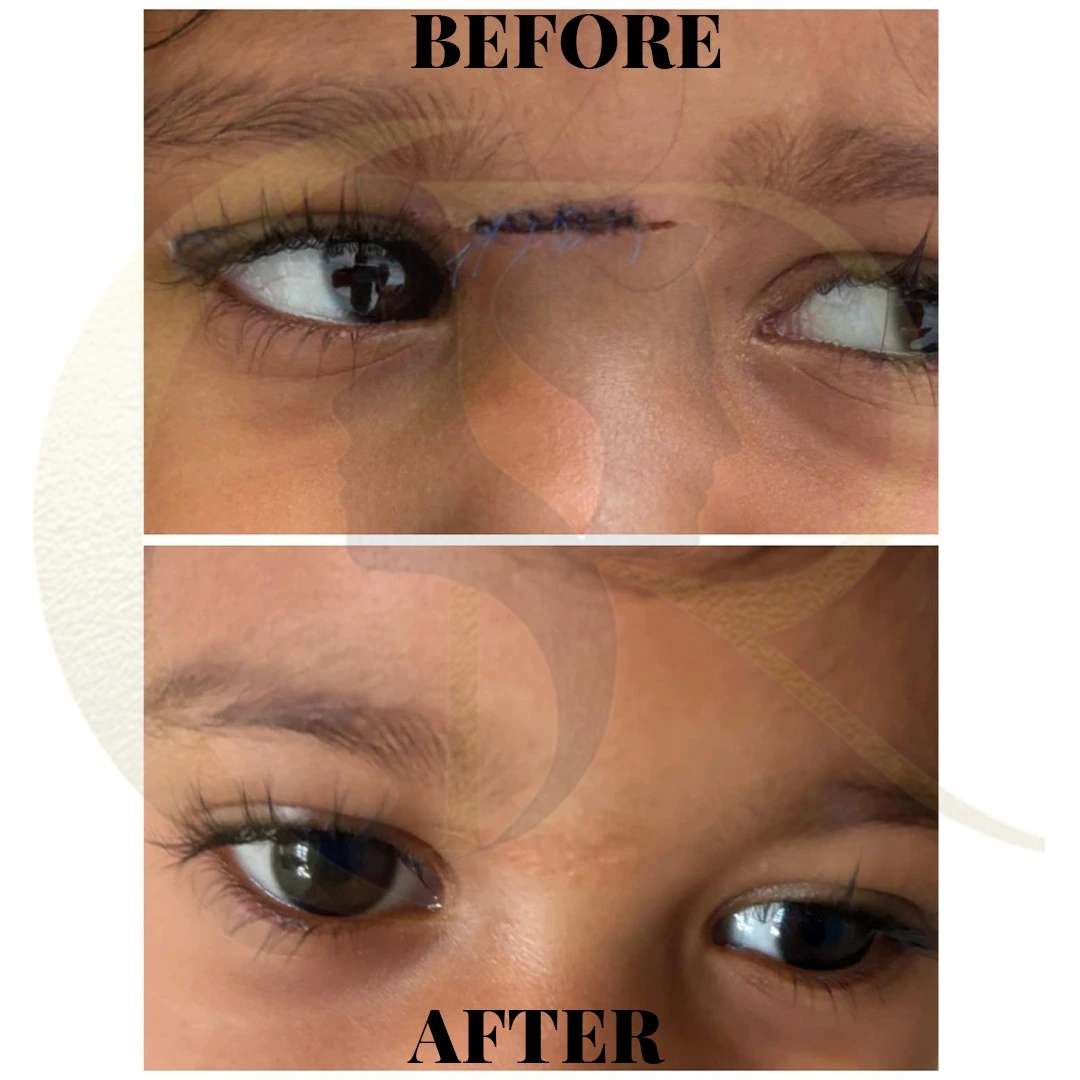 Pediatric facial laceration repair showing soft tissue healing and minimal scarring at Cosmo Radiance Hyderabad India