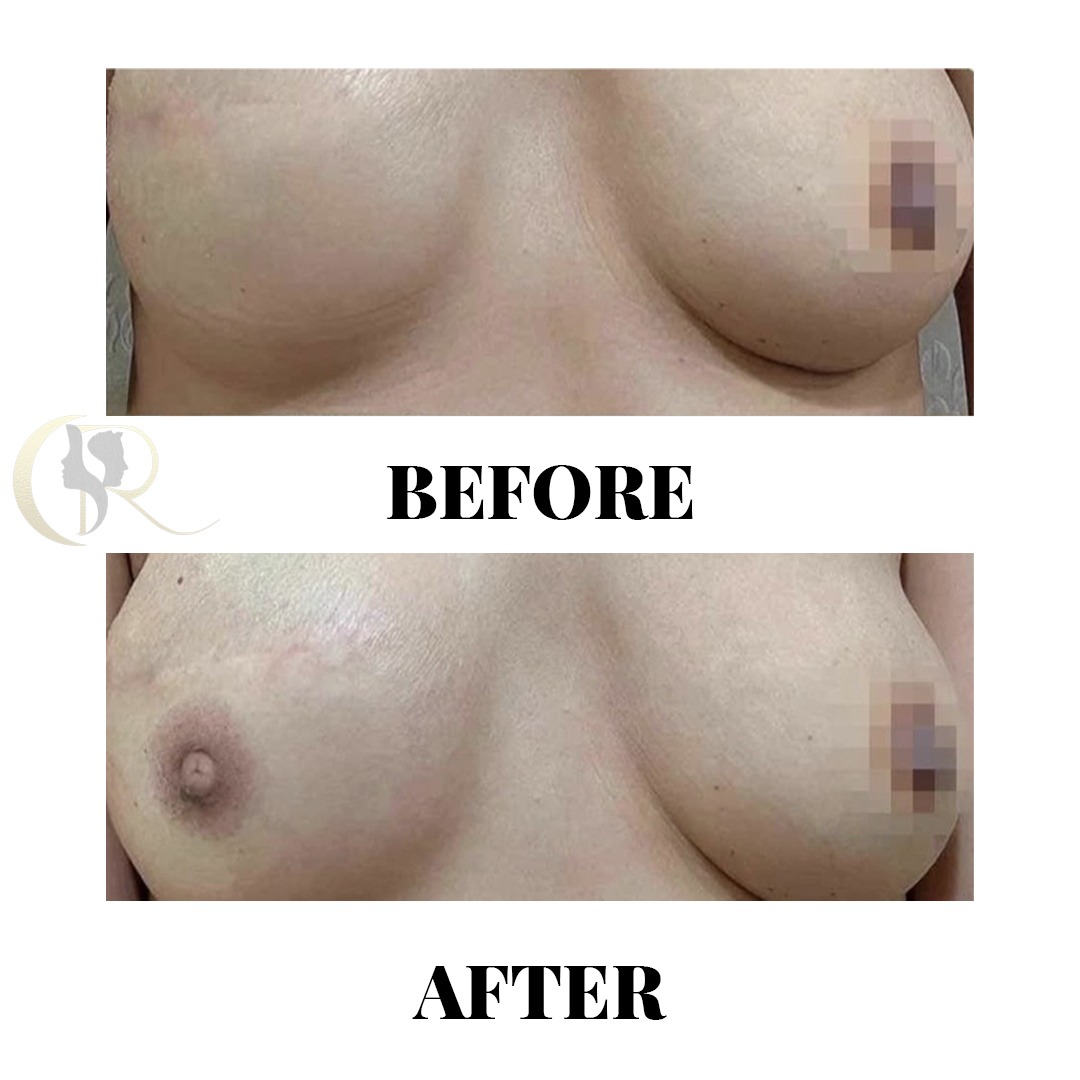 3D Areola and Nipple Complex Reconstruction Before and After 3D Areola and Nipple Complex Reconstruction Before and After