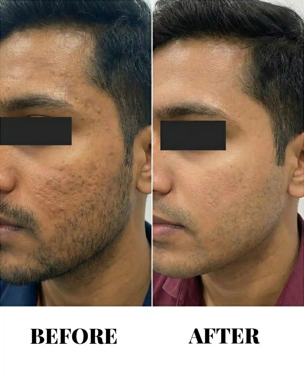 Medical Chemical Peels & Resurfacing in Hyderabad | From ₹4,000 Medical Chemical Peels & Resurfacing in Hyderabad | From ₹4,000