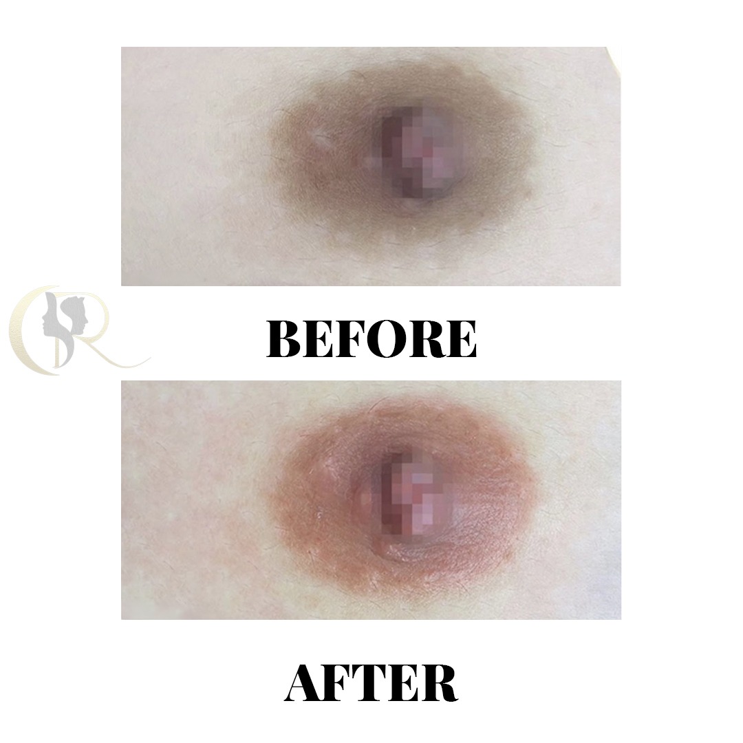 Areola Color Correction and Lightening Before and After Areola Color Correction and Lightening Before and After
