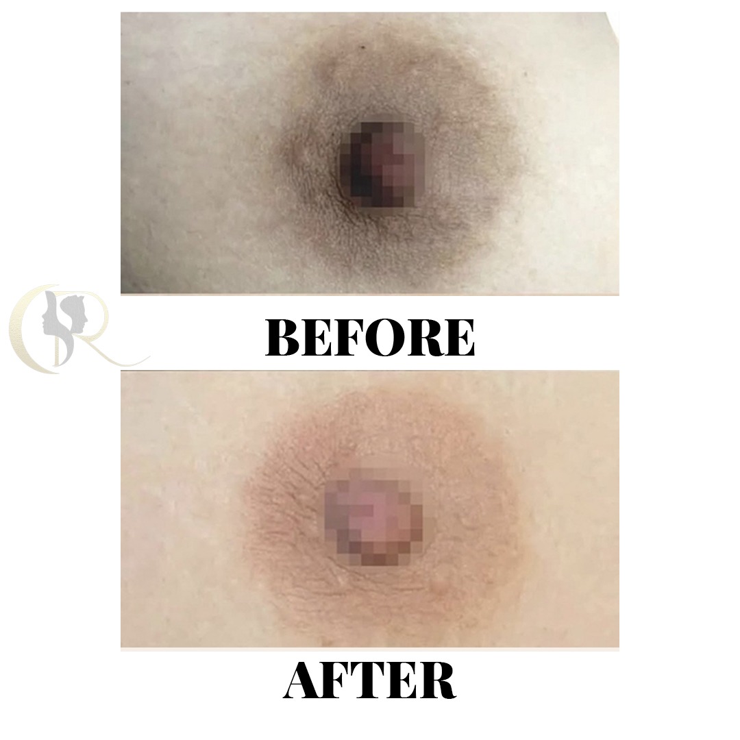 Areola Tone Restoration Before and After Areola Tone Restoration Before and After