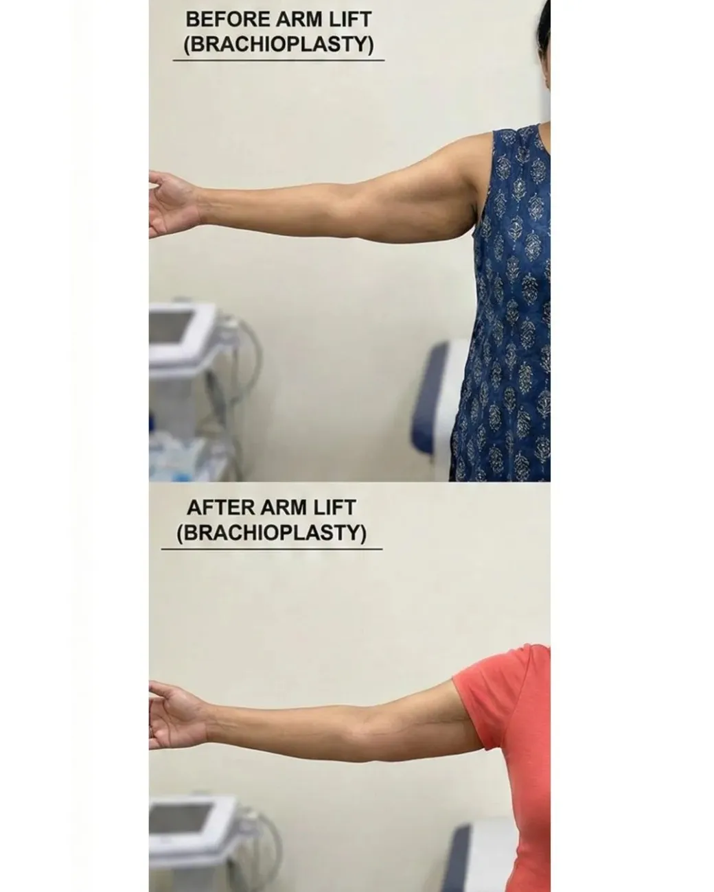 Advanced Arm & Thigh Lift in Hyderabad Advanced Arm & Thigh Lift in Hyderabad