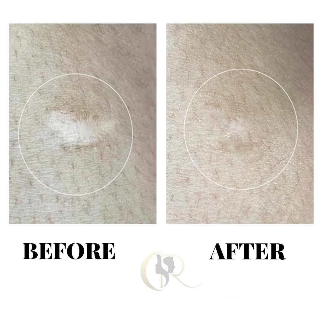 Atrophic Circular Scar Camouflage Before and After Atrophic Circular Scar Camouflage Before and After