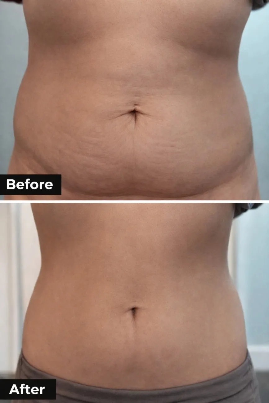 Advanced Injectable Lipolysis & Double Chin Treatment in Hyderabad Advanced Injectable Lipolysis & Double Chin Treatment in Hyderabad