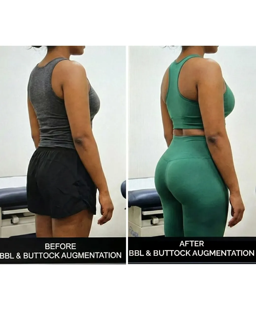 Advanced Brazilian Butt Lift (BBL) in Hyderabad Advanced Brazilian Butt Lift (BBL) in Hyderabad
