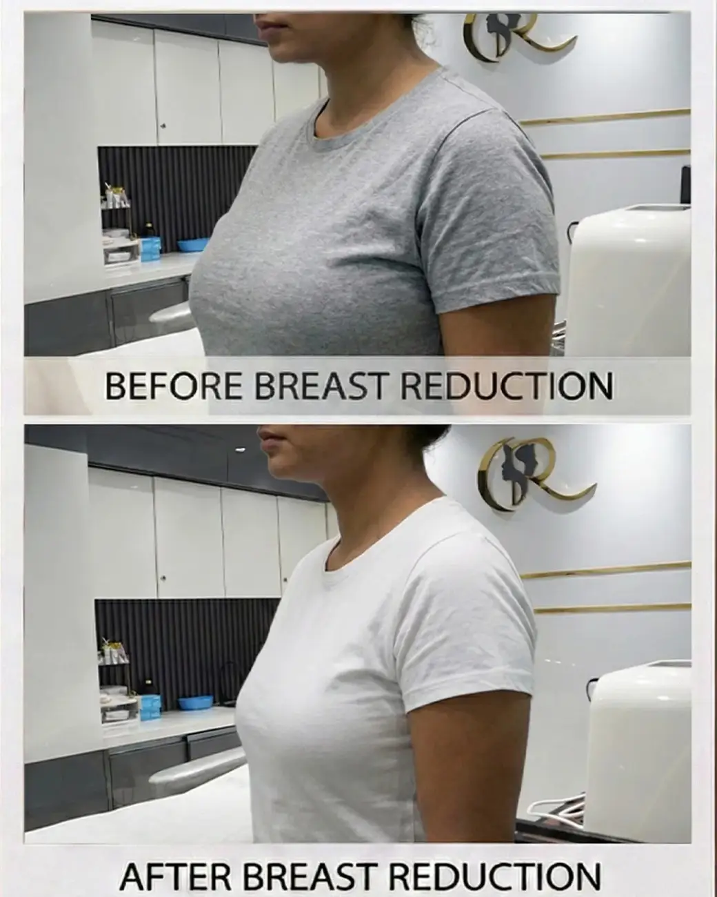 Advanced Breast Reduction Surgery in Hyderabad Advanced Breast Reduction Surgery in Hyderabad