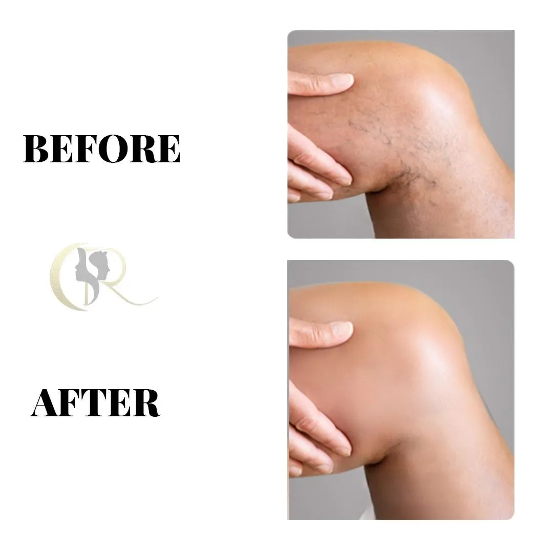 Best Varicose Veins Treatment in Hyderabad | 0% EMI Best Varicose Veins Treatment in Hyderabad | 0% EMI
