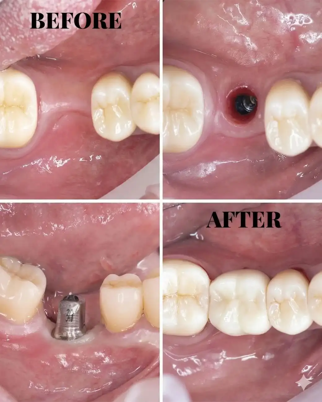 Dental Implants & Full Mouth Rehabilitation in Hyderabad Dental Implants & Full Mouth Rehabilitation in Hyderabad