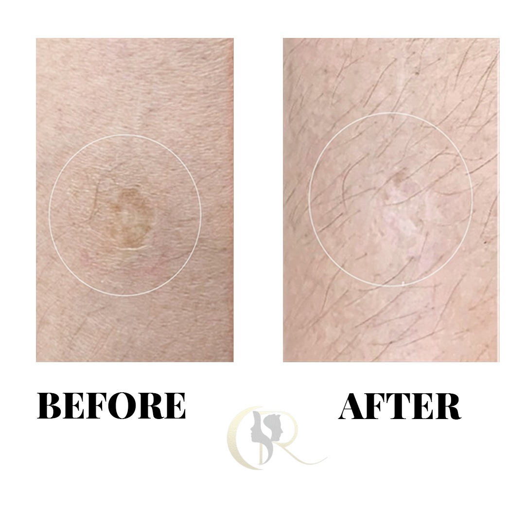Dermal Scar Camouflage Before and After Dermal Scar Camouflage Before and After