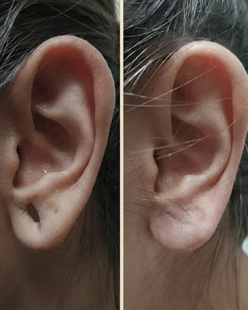 15-Min Ear Hole Repair & Earlobe Repair in Hyderabad 15-Min Ear Hole Repair & Earlobe Repair in Hyderabad