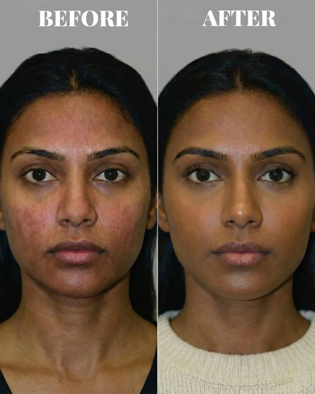 Exosome Cellular Therapy for Face in Hyderabad | From ₹15,000 Exosome Cellular Therapy for Face in Hyderabad | From ₹15,000