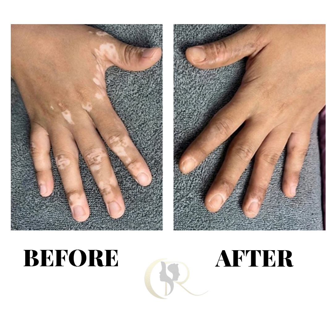 Multi-Digit Vitiligo Camouflage Before and After Multi-Digit Vitiligo Camouflage Before and After