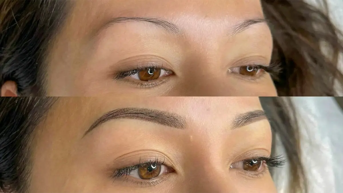 Precision Eyebrow Restoration & Transplant in Hyderabad Precision Eyebrow Restoration & Transplant in Hyderabad