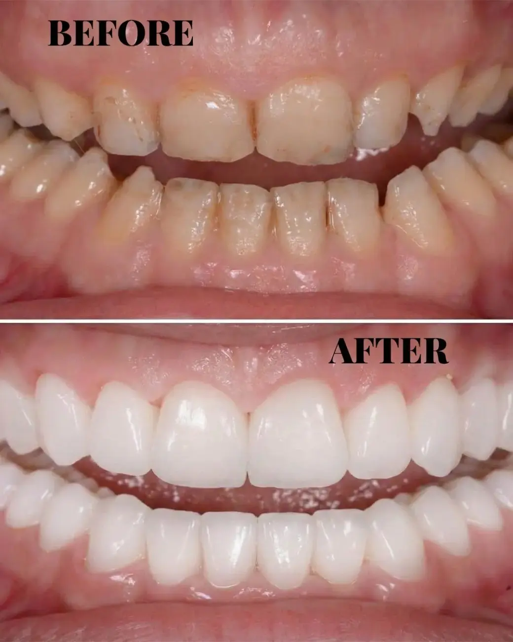 Full Mouth Rehabilitation & Reconstruction in Hyderabad Full Mouth Rehabilitation & Reconstruction in Hyderabad