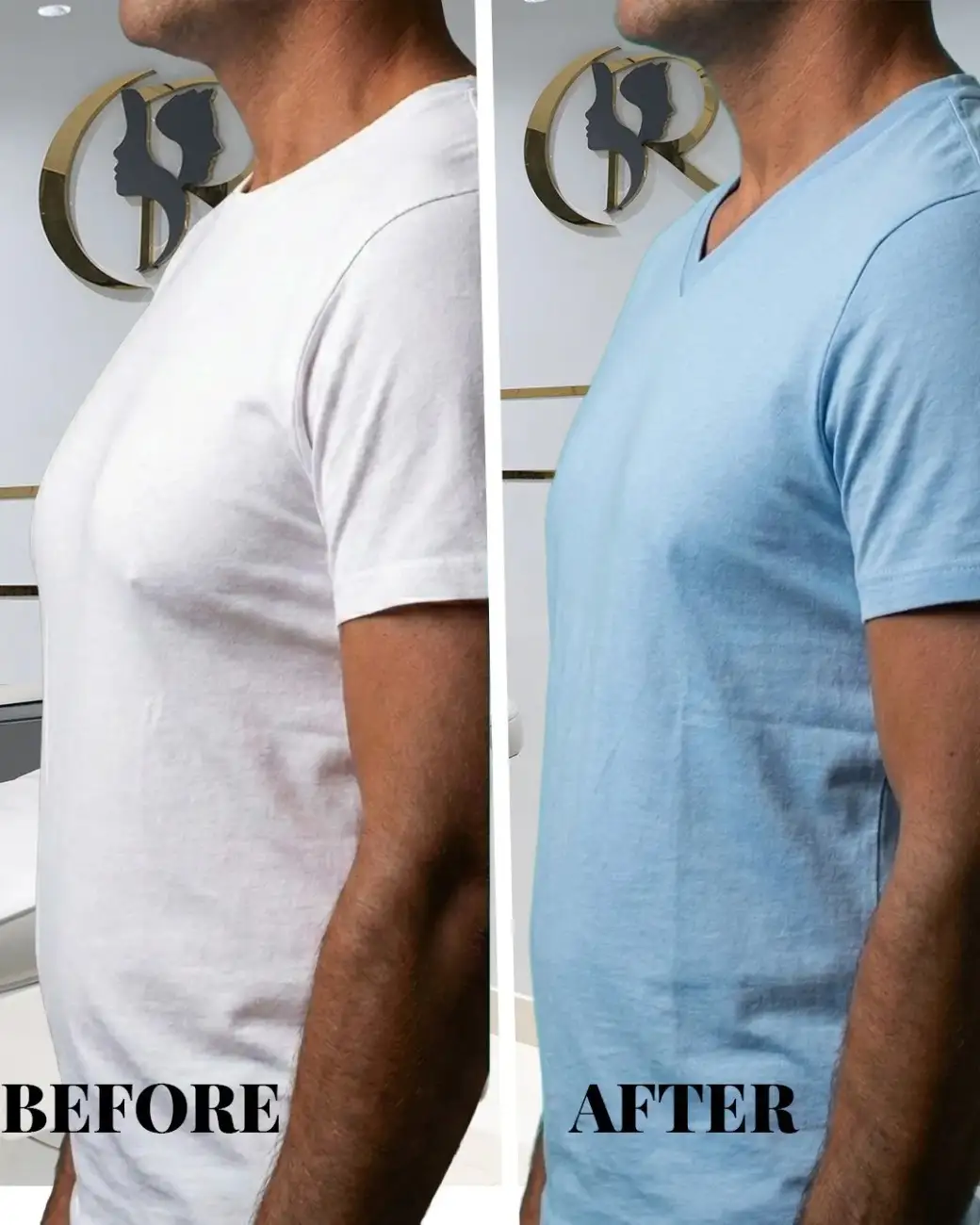 Best Gynecomastia Surgery in Hyderabad | Men Chest Fat Removal Best Gynecomastia Surgery in Hyderabad | Men Chest Fat Removal