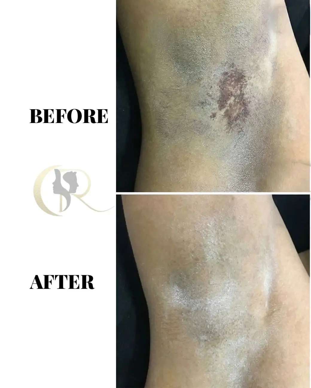 Permanent Excessive Sweating (Hyperhidrosis) Treatment in Hyderabad Permanent Excessive Sweating (Hyperhidrosis) Treatment in Hyderabad