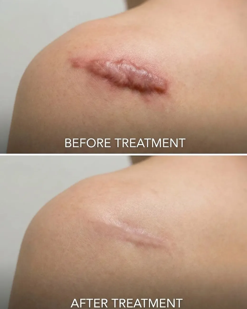 Permanent Keloid Removal & Hypertrophic Scar Treatment in Hyderabad Permanent Keloid Removal & Hypertrophic Scar Treatment in Hyderabad
