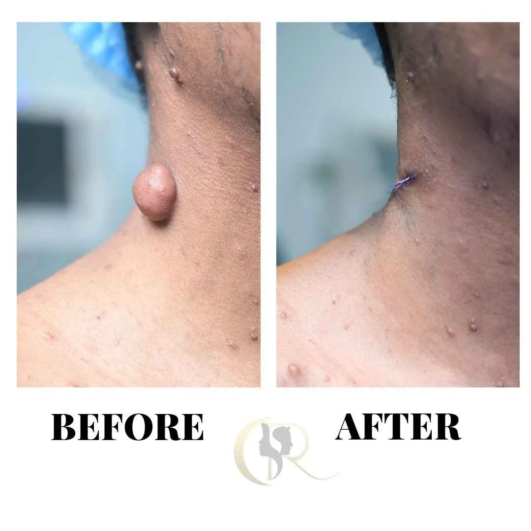 Best Neurofibromatosis Treatment in Hyderabad | Laser & Surgery Best Neurofibromatosis Treatment in Hyderabad | Laser & Surgery