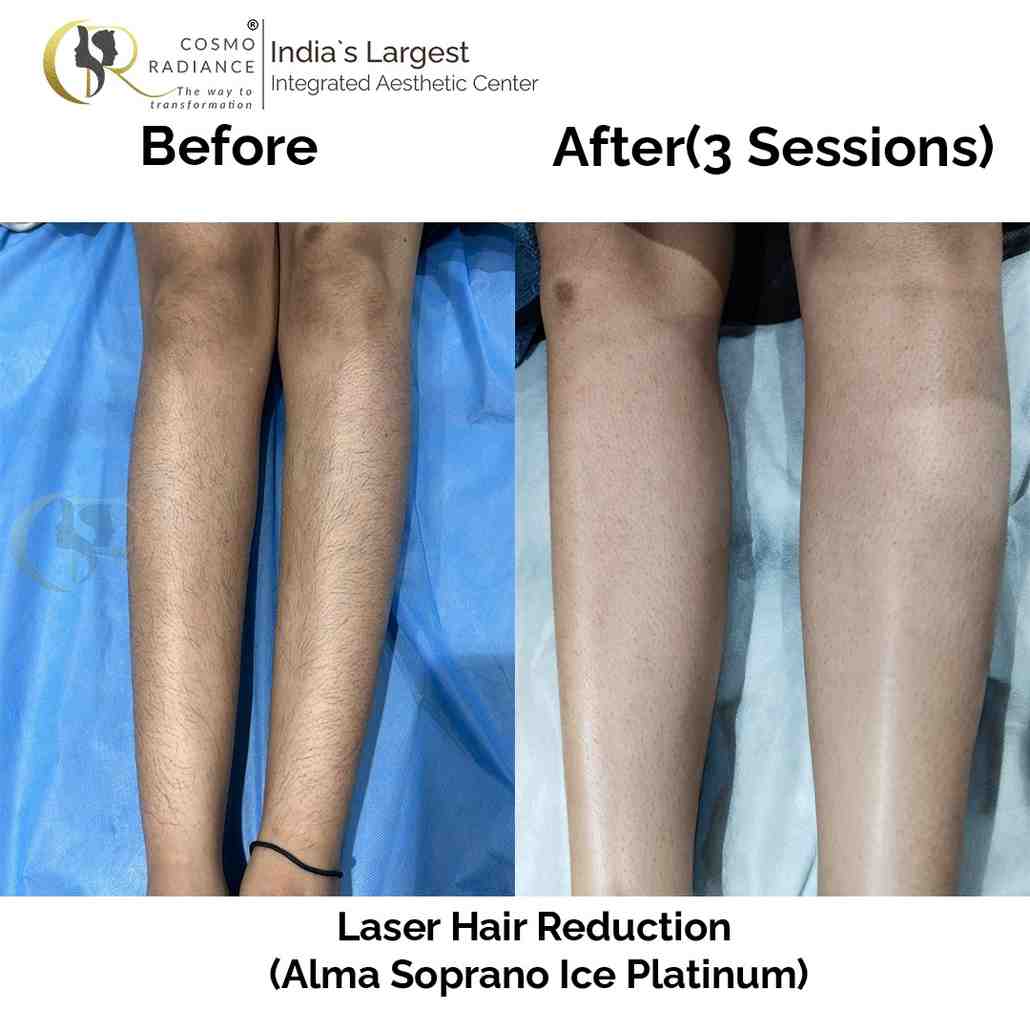 Best Laser Hair Reduction in Hyderabad | Cosmo-Hybrid Precision Protocol (CHPP) Best Laser Hair Reduction in Hyderabad | Cosmo-Hybrid Precision Protocol (CHPP)