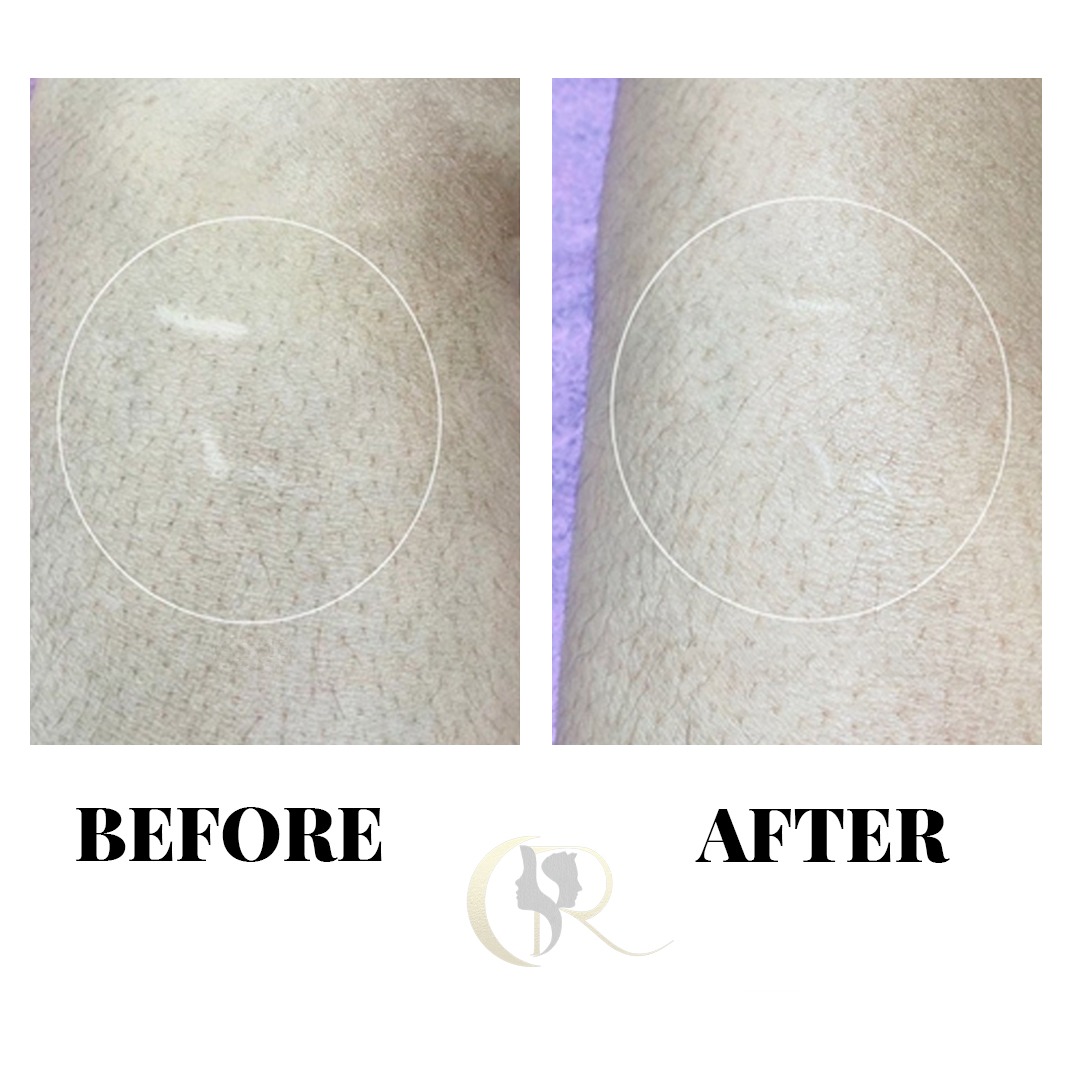Linear Scar Leg Micropigmentation Before and After Linear Scar Leg Micropigmentation Before and After