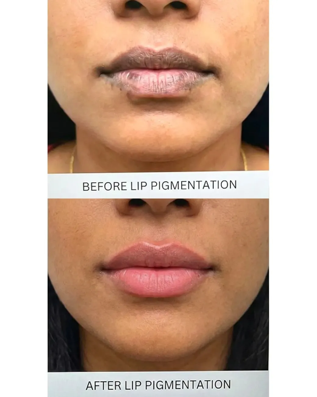 Dark Lips Treatment & Laser Lip Lightening in Hyderabad Dark Lips Treatment & Laser Lip Lightening in Hyderabad